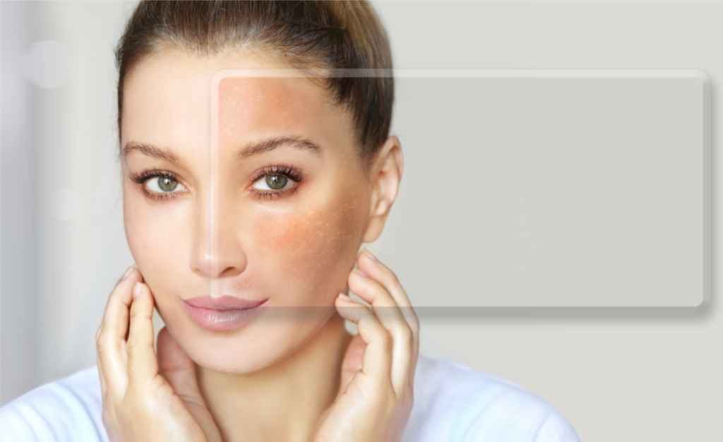 Skinpen Microneedling
