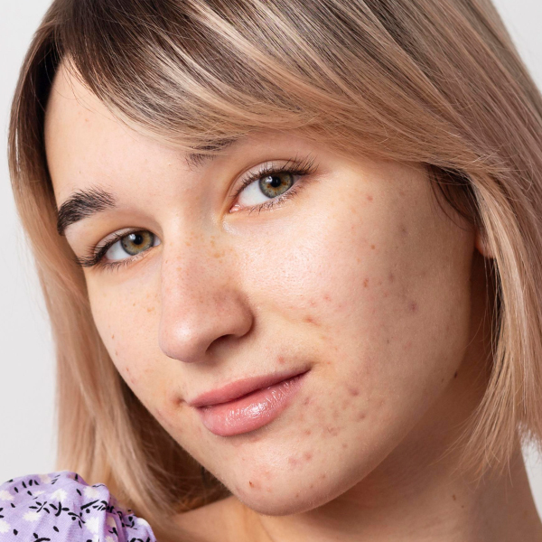 Acnebehandeling Rotterdam