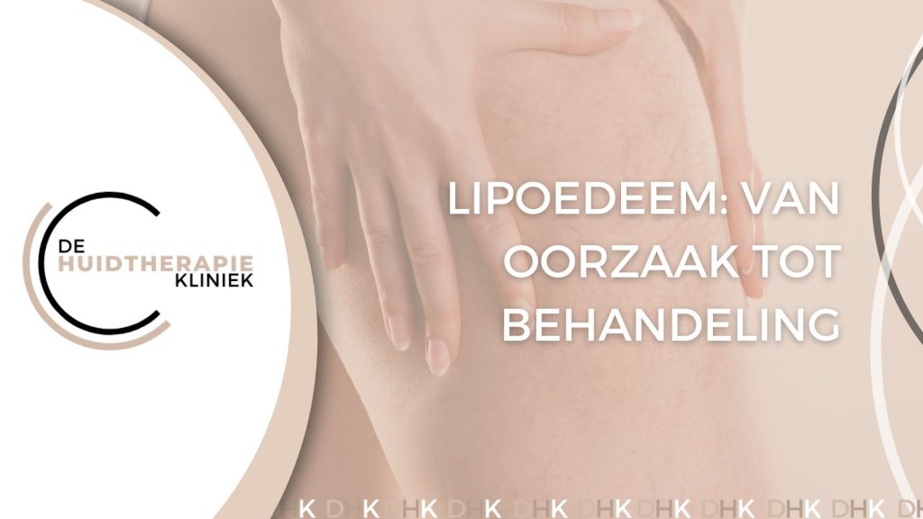Lipoedeem van oorzaak tot behandeling