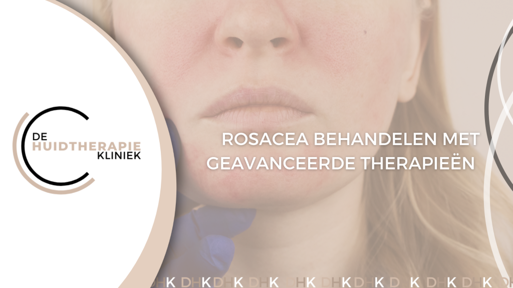 Rosacea behandelen
