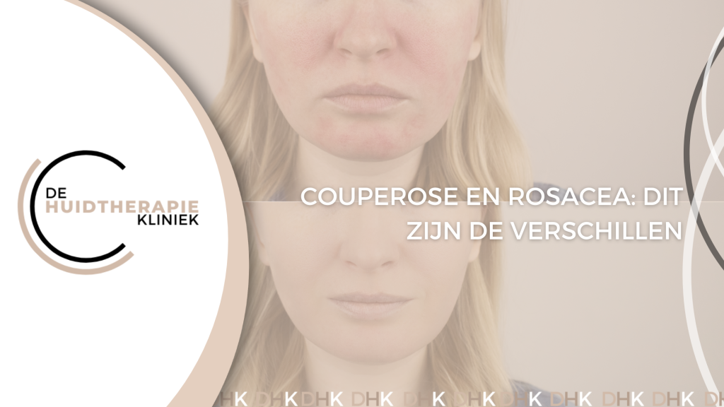 Couperose en rosacea
