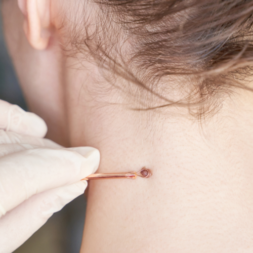 Fibroom verwijderen door coagulatie bij De Huidtherapie Kliniek