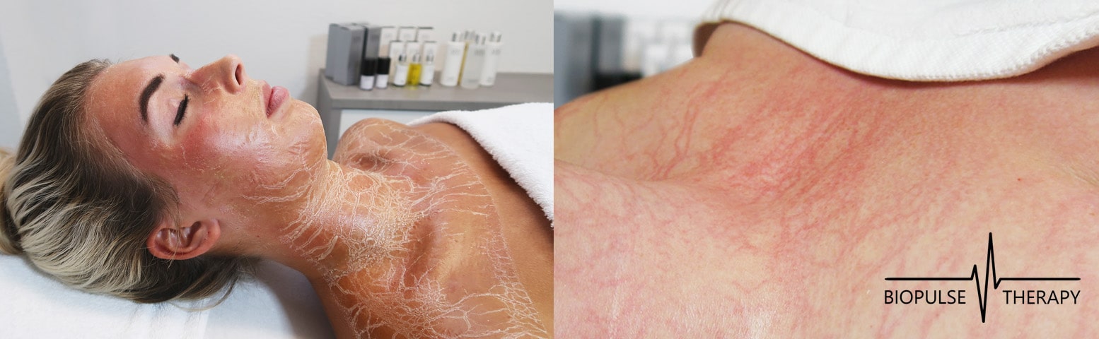 bio pulse therapy tijdens en na