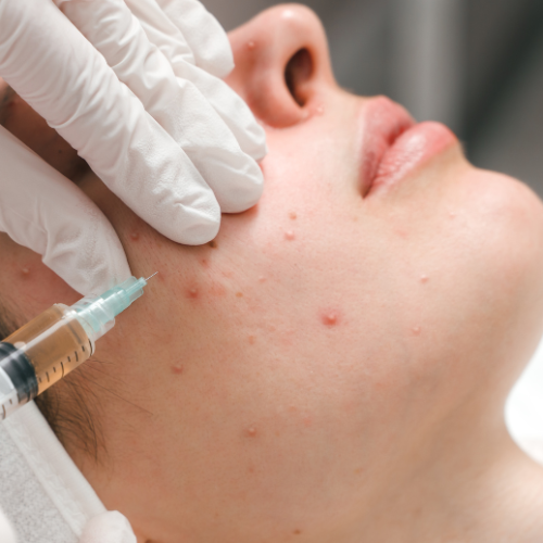 Gezichtsbehandeling tegen acne en littekens bij De Huidtherapie Kliniek

