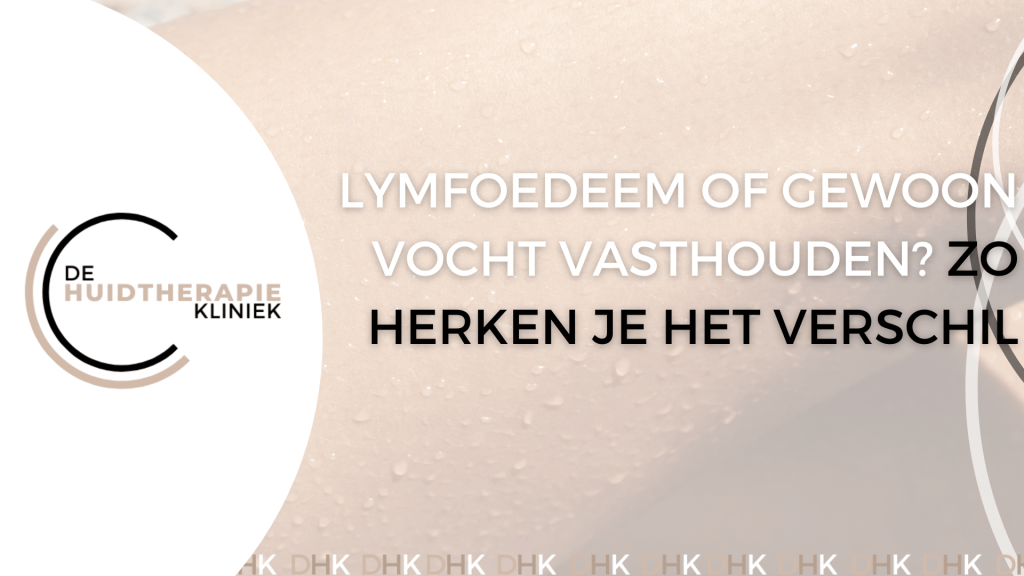 Lymfoedeem of vocht vasthouden?